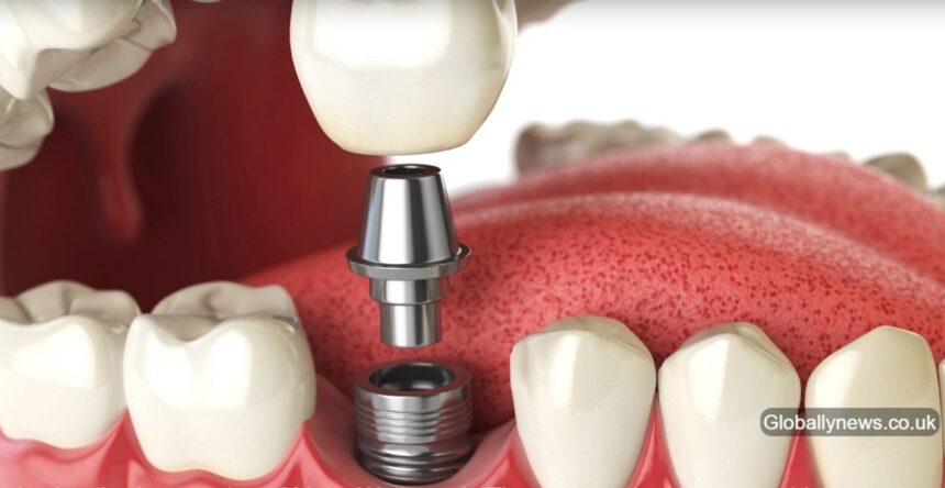 Dental Implants